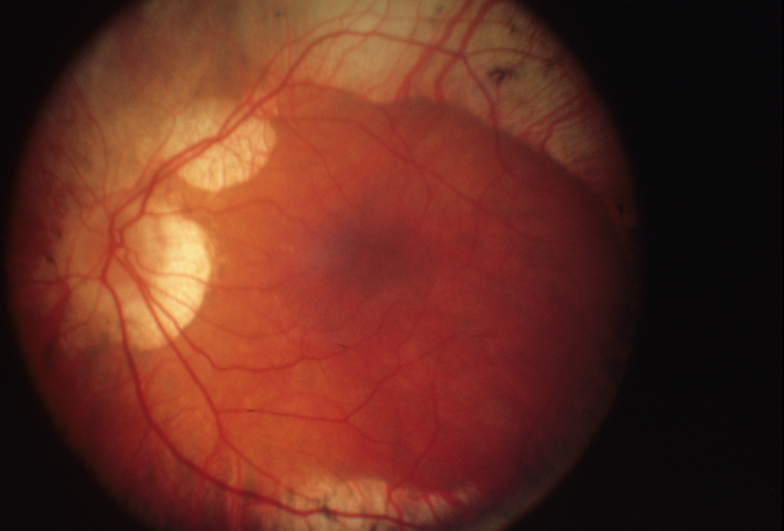 Gyrate Atrophy Hereditary Ocular Diseases 